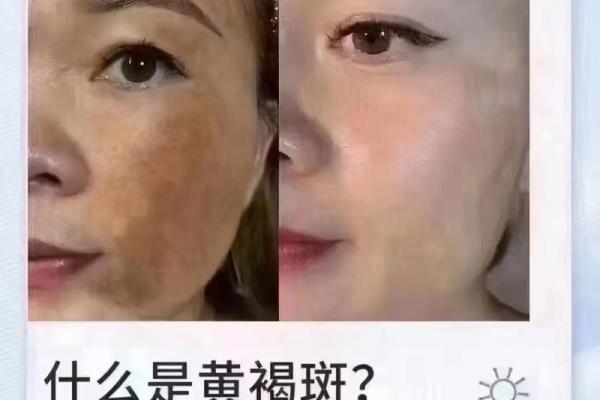 揭秘脸斑的成因与有效护理方法